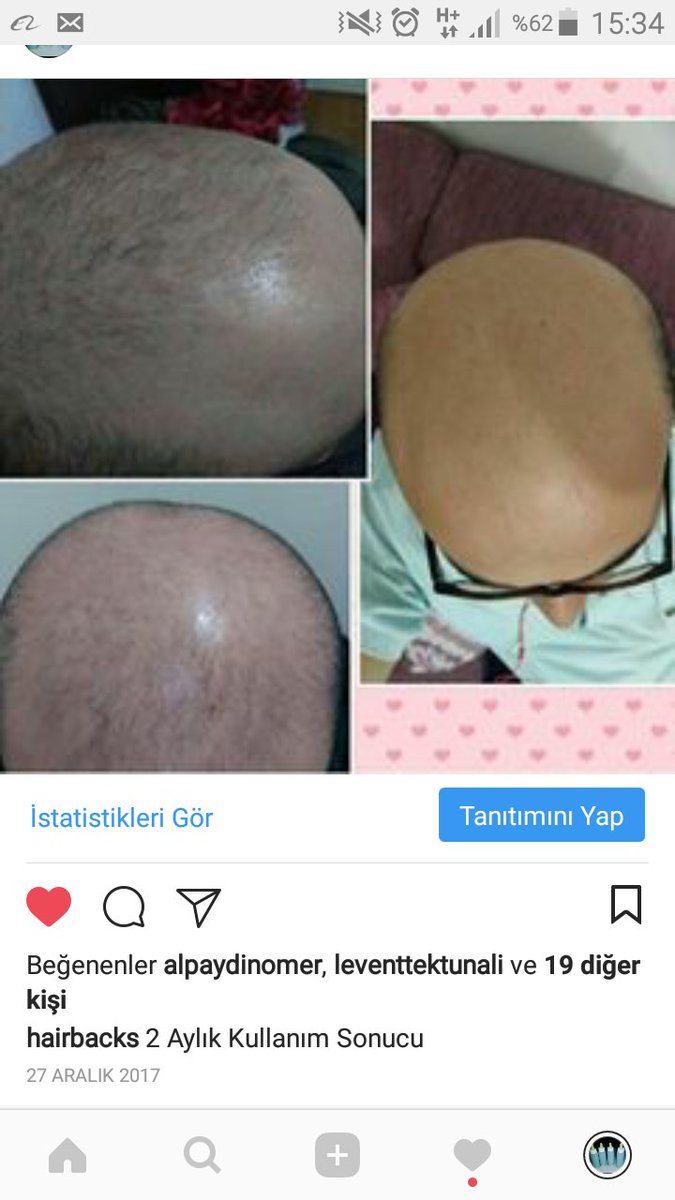 Mucize Solusyon 2 Aylık Kullanım Sonucu 
#hair #saç #sac #saççıkaran #seyreksaç #dökülmüş #dökülmüşsaçlar #dökülensaçlar #yeniçıkansaçlar #saçdeğişimi #saçdeğişikliği #saçdökülmesi #saçilacı #saçsolüsyonu #saçsorunları #sacsorunu #sacsorunlari #saçsorununakesinçözüm #saççıkarıcı