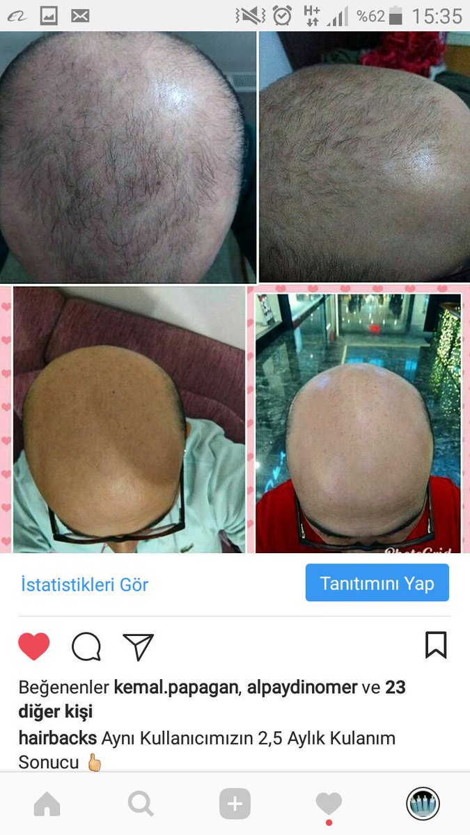 Saç Solusyonu Detaylı Bilgi Ve Sipariş İçin 0552 202 20 30
 #sacinikendinyap #saçlosyon #saçlosyonu  #saçsolusyonu  #sacilacı #hairback #saçekimi #saçekimineson #saçekimineson #saccikarici  #saçgelişimi #saçbesleyici