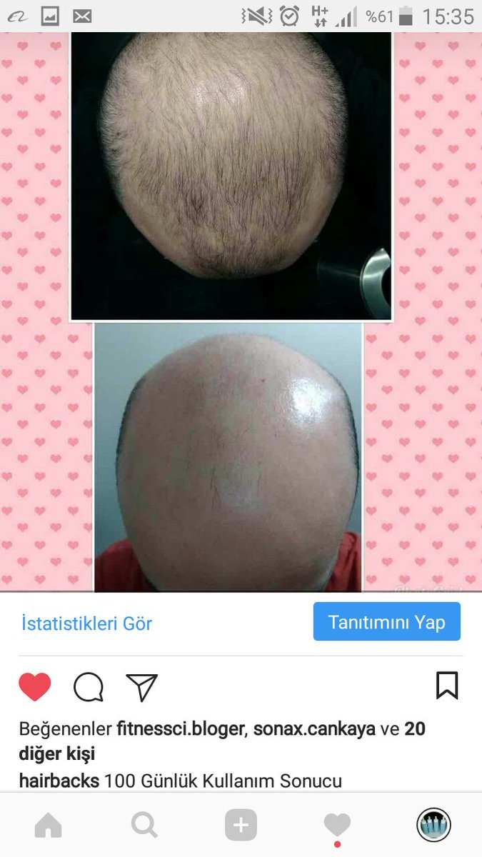 100 Günlük Kullanım Sonucu
#hair #saç #sac #saççıkaran #seyreksaç #dökülmüş #dökülmüşsaçlar #dökülensaçlar #yeniçıkansaçlar #saçdeğişimi #saçdeğişikliği #saçdökülmesi #saçilacı #saçsolüsyonu #saçsorunları #sacsorunu #sacsorunlari #saçsorununakesinçözüm #saççıkarıcı #yenilenme