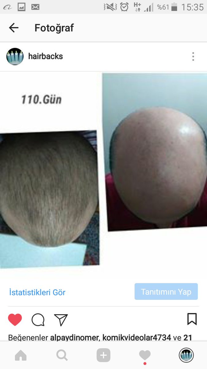 Instagram:hairbacks sayfamızda 100 Kişiye ait öncesi,sonrası fotoğraflar vardır !
#hair #saç #sac #saççıkaran #seyreksaç #dökülmüş #dökülmüşsaçlar #dökülensaçlar #yeniçıkansaçlar #saçdeğişimi #saçdeğişikliği #saçdökülmesi #saçilacı #saçsolüsyonu #saçsorunları #sacsorunu #dökülme