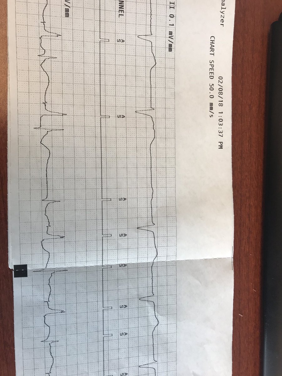 DrSuzyFeigofsky's tweet photo. His pacing for Type I second degree AV block and symptomatic Brady.
Didn’t see His until lead screwed in. #dontdisthehis #EPnerd #womeninmedicine #WomenInSTEM #WomenineEP https://t.co/BnBg9yJ2mI