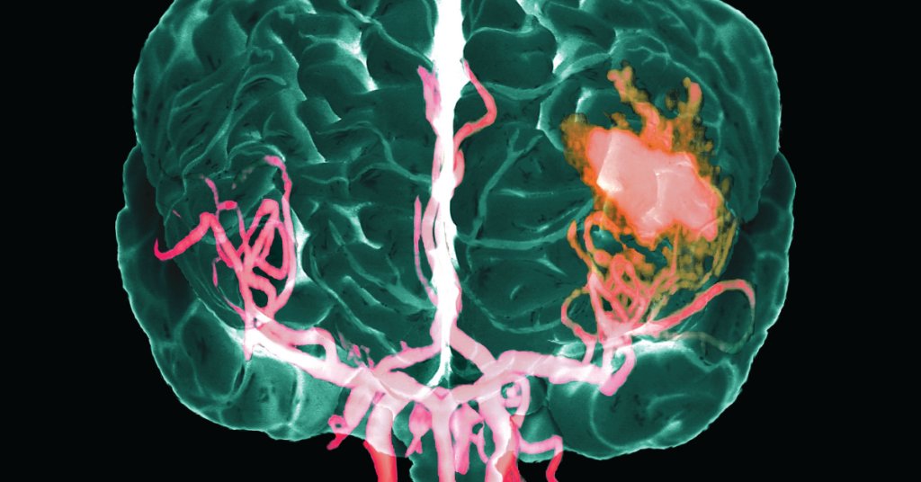 Stroke is the leading cause of disability and the 3rd leading cause of death in U.S. women -- and a new study says these factors may increase women's stroke risk: wb.md/2Ev2ZwC