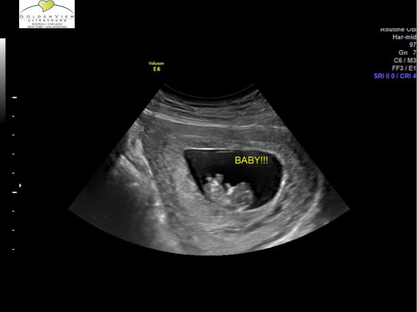3dUltrasound's tweet photo. Goldenview Ultrasound now offers Pregnancy Confirmation using Ultrasound starting at 6 weeks (calculated using LMP)!  
Appointments 7 days a week
Call 888-915-2229 
https://t.co/nFY7I9GQcp https://t.co/GuPm74he6T