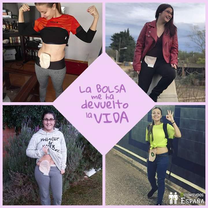 Nuestro primer #FFpaciente es para todos los #ostomizados #Ileostomizados #Ureostomizados #CrohnsDisease y decirles que #OstomiaEsVida