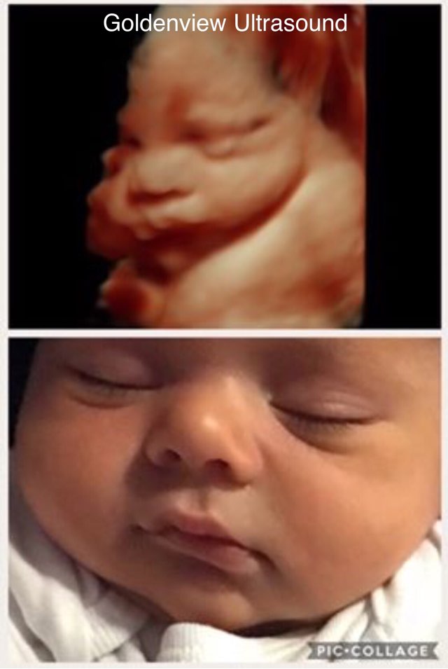 3d4dUltrasound's tweet photo. Can we get some Facebook Love for Carol on the birth of sweet baby Caleb https://t.co/JmwqdbdHf5