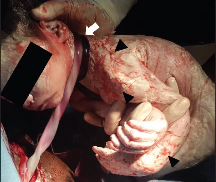 jcollinsmd77's tweet photo. @CHOPFetalCenter Could a tight NC or extremity loop be removed with fetal surgery? https://t.co/KLbyJ5ixpP