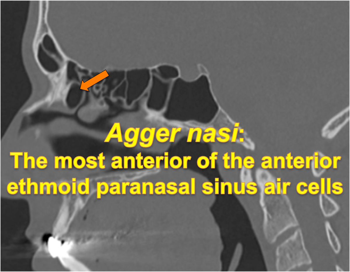 Rad_Bits's tweet photo. Answer Quiz212
#طلاب_الطب #radiology #kku_med #uqumed #UQUMed35 #bu_medicine #radres #medicnina #radiologie @medicine_bu @guide1_me @OneMedZone @educaring_sa #med15 #med16 #med17 #mededucation #rsna2018 #med101 #usmle #ent #pns #usmle1 #usmle2 #FESS https://t.co/N7Gu36w5ml