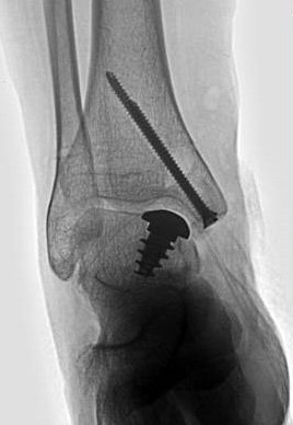 AnikaThera's tweet photo. First Talus HemiCAP Surgery in France was performed this week!
The motion preserving procedure was performed by Prof. Jean Brilhault in a Recurrent OCD after failure of BMS and OATS. The HemiCAP Implant offered a new salvage solution prior to TAR or Fusion. #StayActive #HemiCAP https://t.co/w3JP4GuRGH