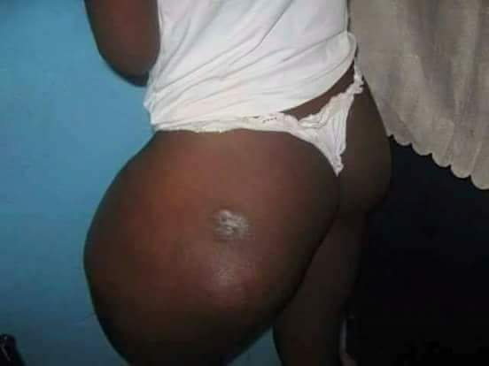 Apparently she went for an injection to make her ass🍑 bigger... &amp; these are the results.

Ladies learn to appreciate your bodies please. 🙏🗣