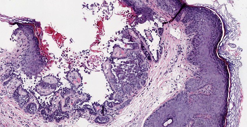 sortizreina's tweet photo. @alwafreih Similary case. Warty dyskeratoma
Female 74YO, keratotic, solitary and umbilicated papula in the ear, filled keratin, parakeratin, acantholytic and dyskeratotic cells, grains and corps ronds.
Suprabasilar acantholytic dyskeratosis and villi into the lacuna.
#dermpath #pathology https://t.co/00t7wVLcg2