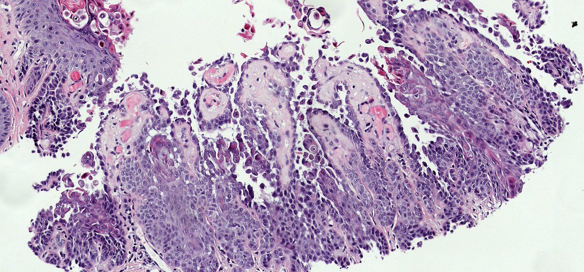 sortizreina's tweet photo. @alwafreih Similary case. Warty dyskeratoma
Female 74YO, keratotic, solitary and umbilicated papula in the ear, filled keratin, parakeratin, acantholytic and dyskeratotic cells, grains and corps ronds.
Suprabasilar acantholytic dyskeratosis and villi into the lacuna.
#dermpath #pathology https://t.co/00t7wVLcg2