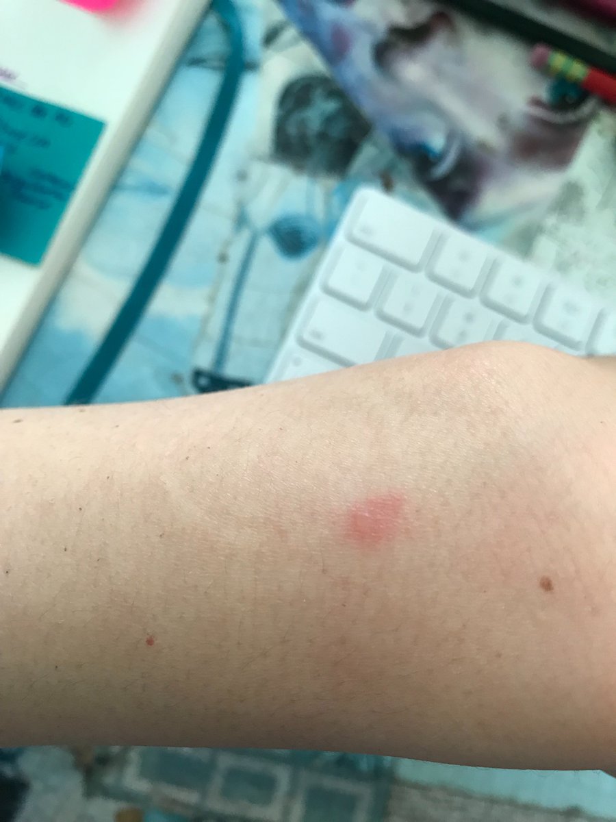 IndieGals's tweet photo. @Apple don't want to alert you, but is it normal for the Apple watch to burn the skin a little bit? Or was it just working really hard to find my heart rate? Or is it my husband's way of gifting me something that will kill me slowly? So many questions. 🧐 https://t.co/0vw7lUZiYQ