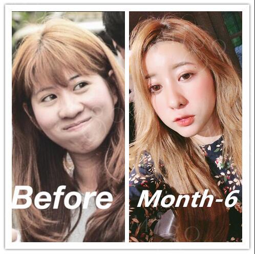 Migo_Clinic's tweet photo. Welcome to consult! #migoplasticsurgery #migoclinic #beforeandafter #instabeauty #plasticsurgerykorea #korea #seoul #beforeandafter #cheekbonereduction #rhinoplasty #fatgraft #darkcycle #travel #韩国整形 #整容 #整形外科 #ศัลยกรรมเกาหลี #มีโก้พลาสติกเซอเจอรี่ #KhuônmẫuHànQuốc https://t.co/qSA4zhde2j