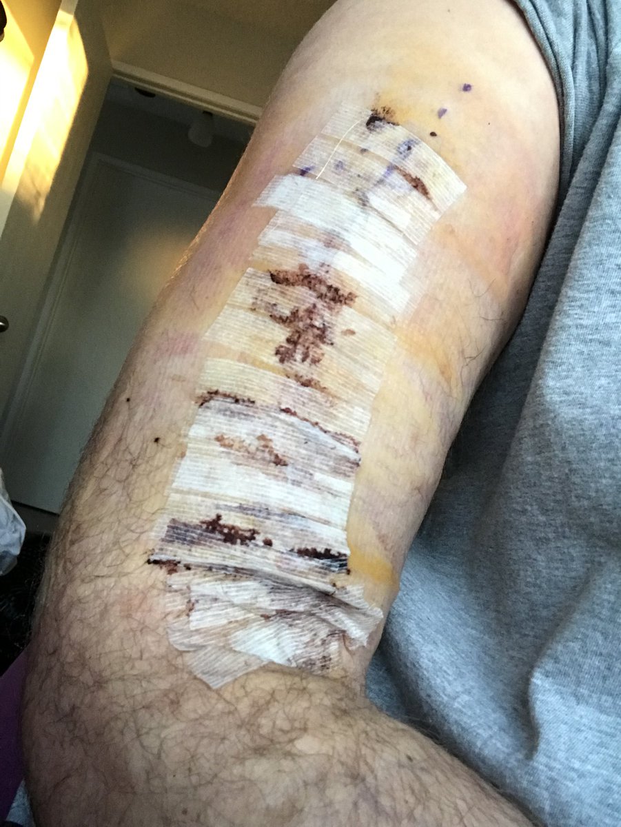 scienceSkori's tweet photo. I am always thankful for universal healthcare in Canada. May never pitch competitively again but hell at least it’s not my pipetting hand. Lots of molecular work to do this month. #scientistproblems #baseballproblems #pitcherproblems #nothumerus https://t.co/CCRm4o6kNE