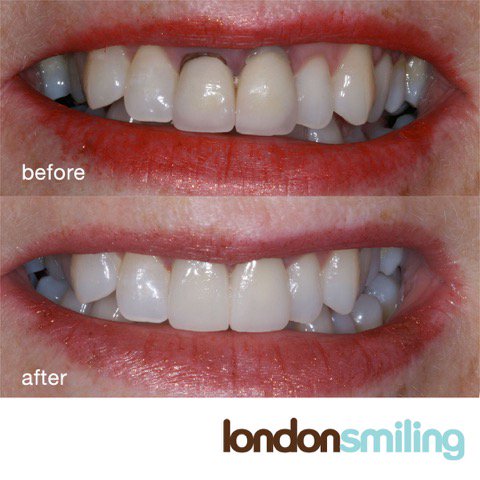 LondonSmiling's tweet image. Know anyone with old crowns and self-conscious about a grey line on their gum? @druchennaokoye created a stunning smile for her with cosmetic dentistry. We focus on natural bespoke smiles, because we are all unique. #smileconfidence #keep smiling #smileexpert #cosmeticdentist