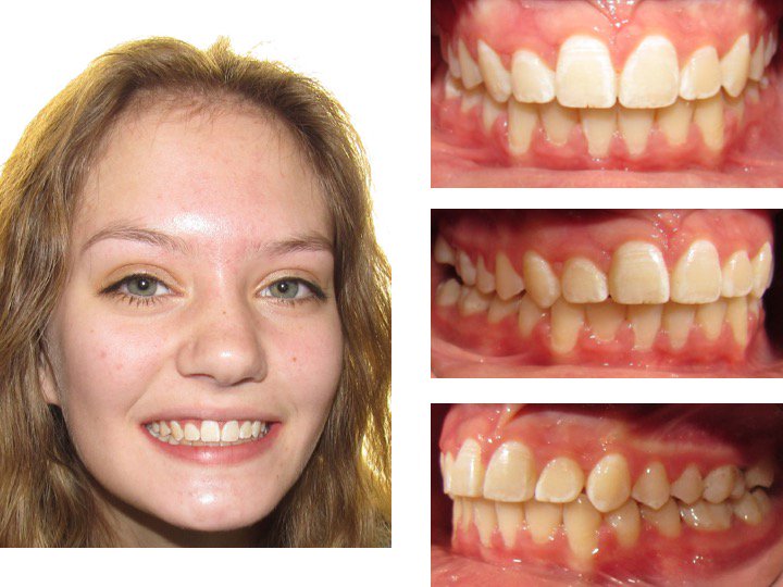 Stephen Murray On Twitter How Did He Correct The Buccal Segment