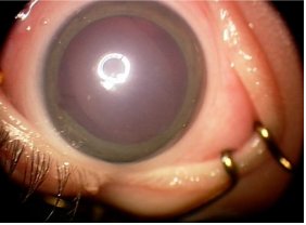 OphthaTweets's tweet photo. Nonaccidental injury presenting as unilateral Retinal Detachment in two infants https://t.co/3KnOyPxWhu via #JAAPOS https://t.co/PWPsMIQYvR