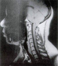 AANSNeuro's tweet photo. Learn about the symptoms, diagnosis and treatments of Chiari malformations: https://t.co/Qf56VtruWH https://t.co/ckaSr33PCl