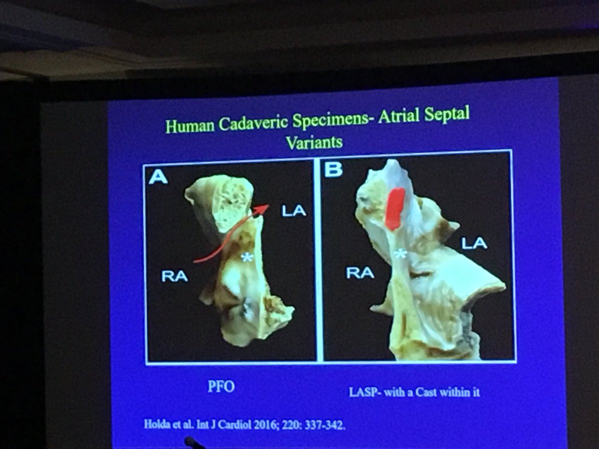 IslaaFoundation's tweet photo. Sumbramaniam Krishnan (CK) showsamazing data on the role atrial septal pouches as non-LAA sources of clot @HRSonline @ACCCardioEd @andreanatalemd @IslaaFoundation @DJ_Lakkireddy #ISLAA2018 https://t.co/4QkVEyqPdo