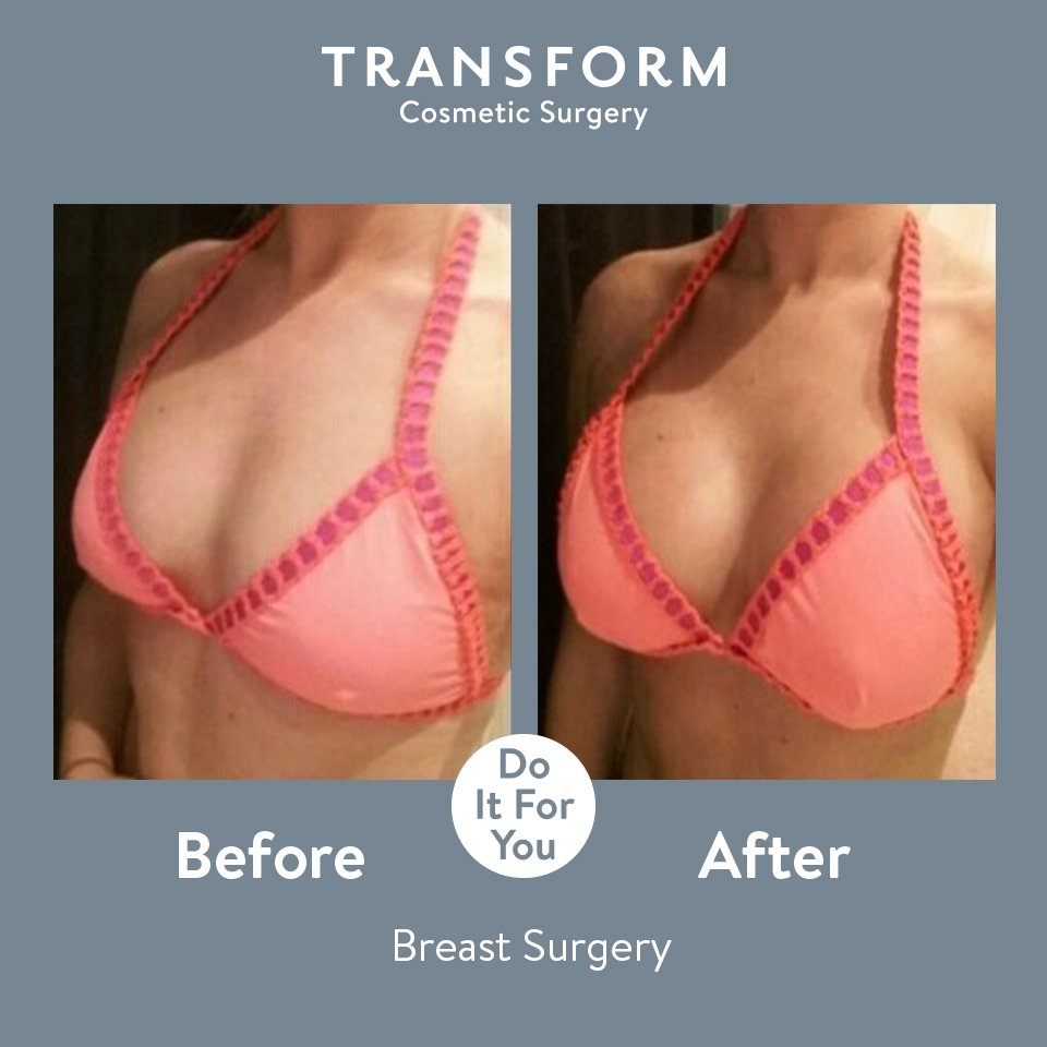 Boobwave Breast Augmentation By Rasburton D Ymcde Breast Expansion