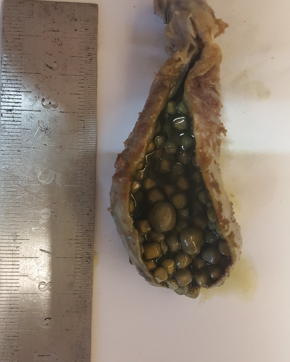 ozkanaydin1986's tweet photo. Gallbladder stones #gallbladder #gispath #pathology @ozkanaydin1986 https://t.co/QP8NiSzZsw
