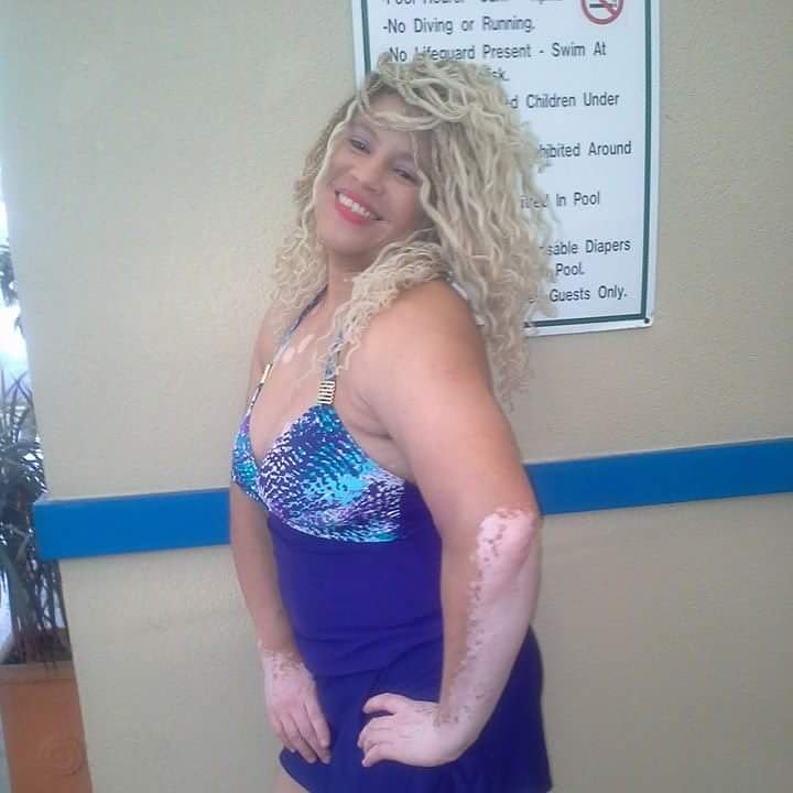 dapurplediva's tweet photo. @Epic_Women USeeME thx #vitiligo4life #VITILIGOWOMAN #Vitiligostrong embrace da skin I'm N #VITILIGOFAMILY #WEAREVITILIGANS #cantcuredopeskin https://t.co/7OCdvKwH8N