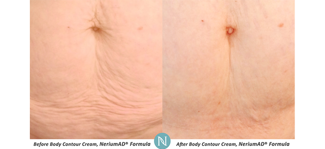 Emma_Lee989's tweet photo. I have been sharing the results of Neirum for over 18 months now and am yet to run out of before and afters...like this one 😱 from Beth 90 days #nerium #stretchmarks #agedefying #skincare #beauty https://t.co/ukNE18i9mE