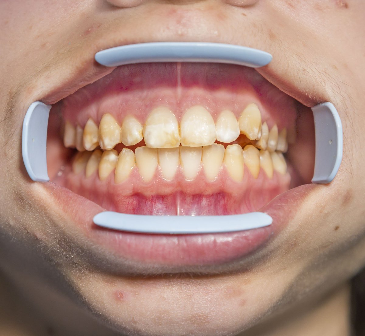 tooth enamel and fluoride How to restore tooth enamel over time brushing your teeth twice a day with a fluoride toothpaste may help restore enamel or prevent further loss of it. tooth enamel and fluoride How to restore tooth enamel over time brushing your teeth twice a day with a fluoride toothpaste may help restore enamel or prevent further loss of it.