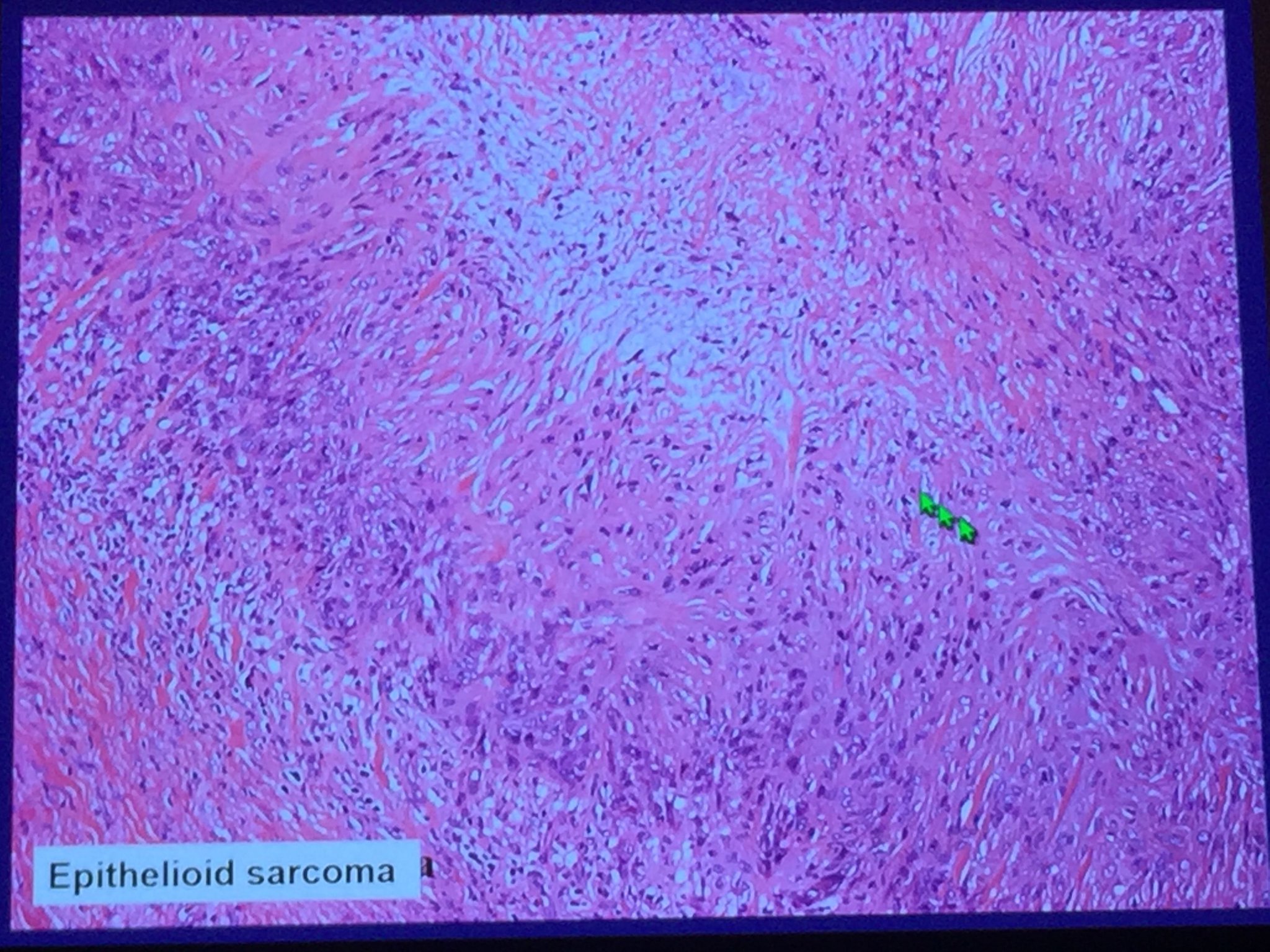 Jerad Gardner, MD on Twitter "Epithelioid Epithelioid