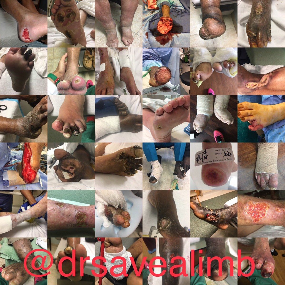drsavealimb's tweet image. #limbsalvage, A process not a procedure, a calling not a job, and we save limbs to save lives! Spread the good word against #Amputation and #stopthechop with dedicated #CLIFighters @SOBE_Vascular @Mustapja @SriniTummala @FadiSaab17 @SDhandMD @AlexCVIR  @keithppereira @bsc_pi