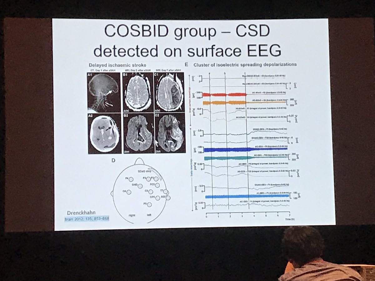 drdangayach's tweet image. @SCCM #CCC47 @NeuroLlama @zlhickman @JoshBedersonMD @MountSinaiNeuro Neuromonitoring: detection of cortical spreading depolarization