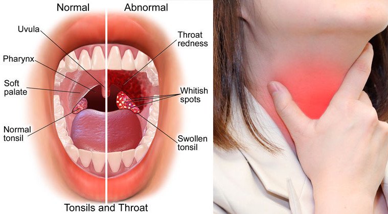 ayurvedicpharma's tweet photo. #Gargling with #salt_water loosens excess mucus and removes bacteria and fungi from the #throat.it can provide temporary relief for sore, itchy throats. Dissolve 1/4 to 1/2 teaspoon salt in 1 cup of warm water. @ayurvedalia https://t.co/nP2rleoy0s https://t.co/lsI27JJrfI