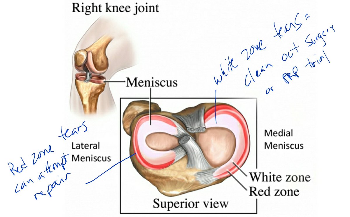 Featured image of post Meniscus White And Red Zone : As mentioned previously, some meniscal tears would require surgery.