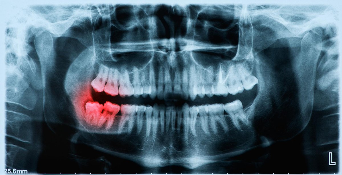 Did you know? Wisdom teeth can lead to infections, lesions, cysts, tumors or damage to adjacent teeth. Be sure to get them removed when you need to.