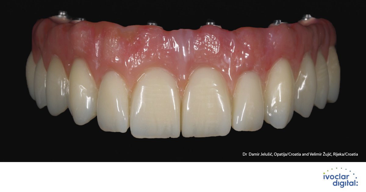 Titanium restorations ideally veneered with SR Nexco. SR Nexco is suitable for veneering titanium frameworks, e.g. Colado CAD Ti2 and Ti5. Work of Dr Damir Jelušić, Opatija / Croatia and Velimir Žujić, Rijeka/Croatia. #ivoclardigital bit.ly/2hAOr14