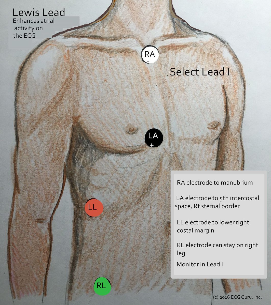 EMS1's tweet photo. 10 tips to never miss atrial flutter with 2:1 conduction https://t.co/3nNu9rVGGA https://t.co/uwh4q0J5aj
