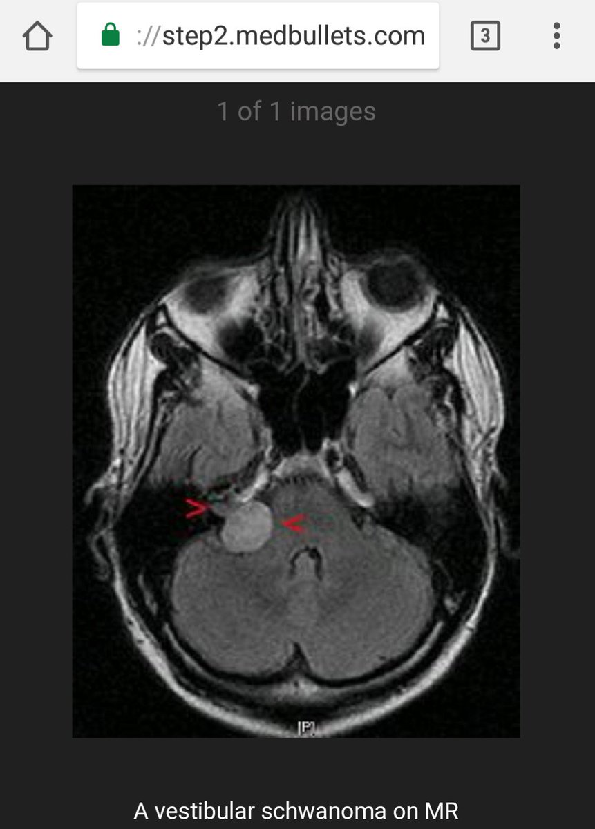 SEMDocs's tweet photo. Acoustic Neuroma: Arises in the cerebellopontine angle

Increased incidence in NF2 patients

Most commonly a benign schwannoma

CF: Tinnitus (VIII), Deafness (VIII), Sensory changes in the face (V), Vertigo, NV, Nystagmus &amp; Ataxia

#FOAMrad
#Neurology
#medbullets
#NeuroRad
#meded https://t.co/HH0Avtjz05