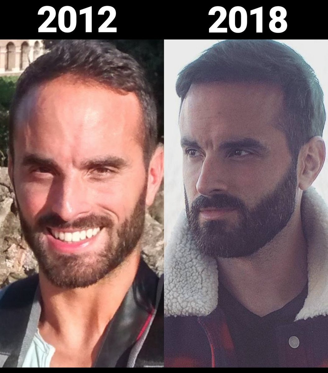 Winslegue on twitter: "6 ans et une greffe de cheveux plus tard 😊