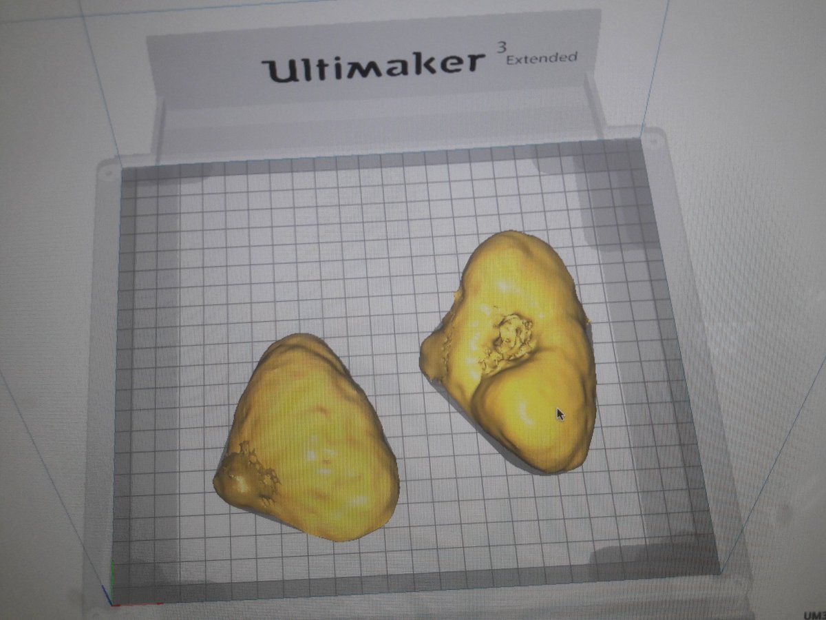3DGabBME's tweet photo. 3d printing of a kidney and associated tumor for a surgical guide at @3d_maranon. @calvoharo_ja 
@rupermac @Ultimaker @CharlieMonitor @BiomedAdrian @BiomedEstefania https://t.co/uB89wwBigJ