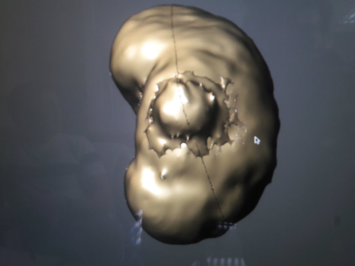 3DGabBME's tweet photo. 3d printing of a kidney and associated tumor for a surgical guide at @3d_maranon. @calvoharo_ja 
@rupermac @Ultimaker @CharlieMonitor @BiomedAdrian @BiomedEstefania https://t.co/uB89wwBigJ