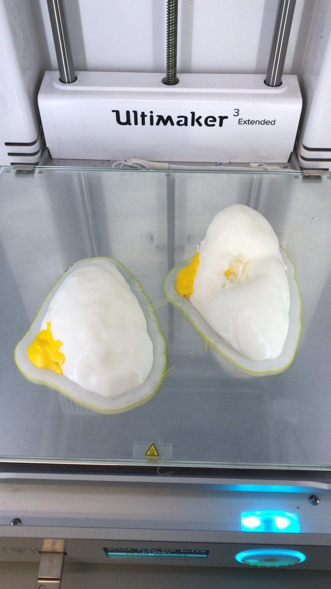 GabrielBME (@3dgabbme) on Twitter photo 3d printing of a kidney and associated tumor for a surgical guide at <a href="/3d_maranon/">FabLab 3D Hospital Marañón</a>. <a href="/calvoharo_ja/">José Antonio Calvo</a>
<a href="/rupermac/">Rubén Pérez-Mañanes, MD PhD</a> <a href="/Ultimaker/">UltiMaker</a> <a href="/CharlieMonitor/">Charlie Molitor</a> @BiomedAdrian <a href="/BiomedEstefania/">Estefanía</a> 3d printing of a kidney and associated tumor for a surgical guide at <a href="/3d_maranon/">FabLab 3D Hospital Marañón</a>. <a href="/calvoharo_ja/">José Antonio Calvo</a>
<a href="/rupermac/">Rubén Pérez-Mañanes, MD PhD</a> <a href="/Ultimaker/">UltiMaker</a> <a href="/CharlieMonitor/">Charlie Molitor</a> @BiomedAdrian <a href="/BiomedEstefania/">Estefanía</a>