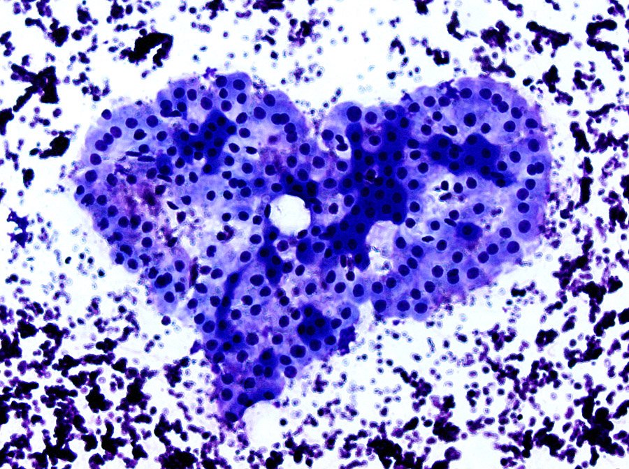 CancerCytopath's tweet photo. Dear fellow #cytopaths, our "heart" belongs to you! Happy Valentine's Day from all of us at the editorial office. Credit to our EIC @celestepowersmd for sending us this heart-shaped #cytology smear from her collection. @DianaEstherossi @marthabpitman https://t.co/Cnb8qVWyI6