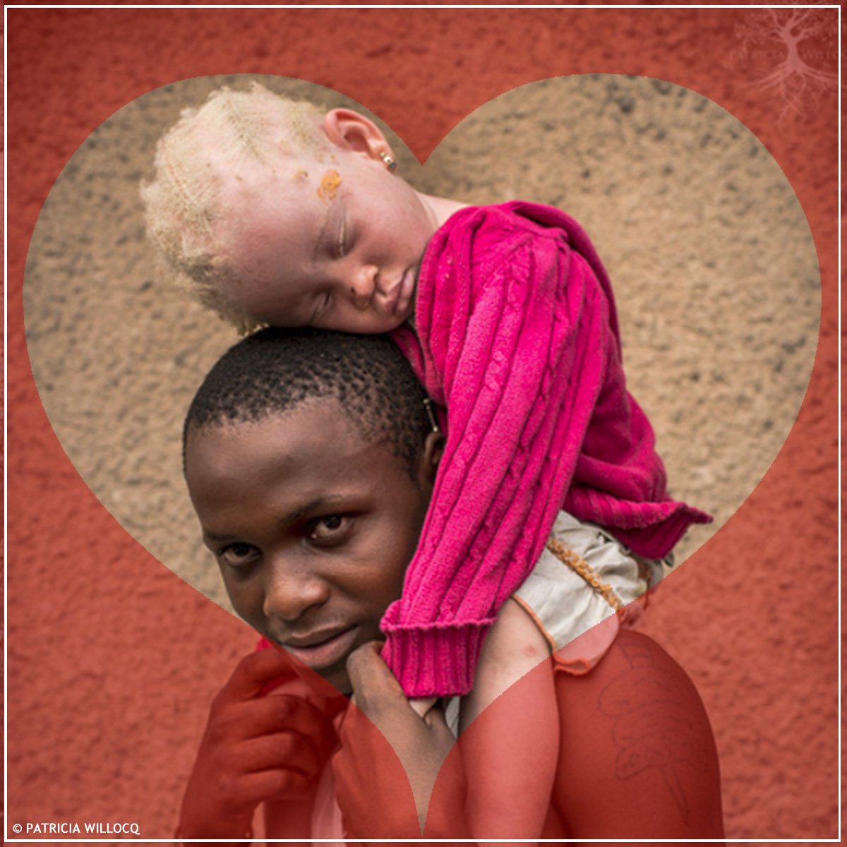 UNICEF_Moz's tweet photo. On this #ValentinesDay lets support & love children with albinism. STOP violence & discrimination against #ChildrenWithAlbinism. #TodosIguais https://t.co/7W1OFpEKGf