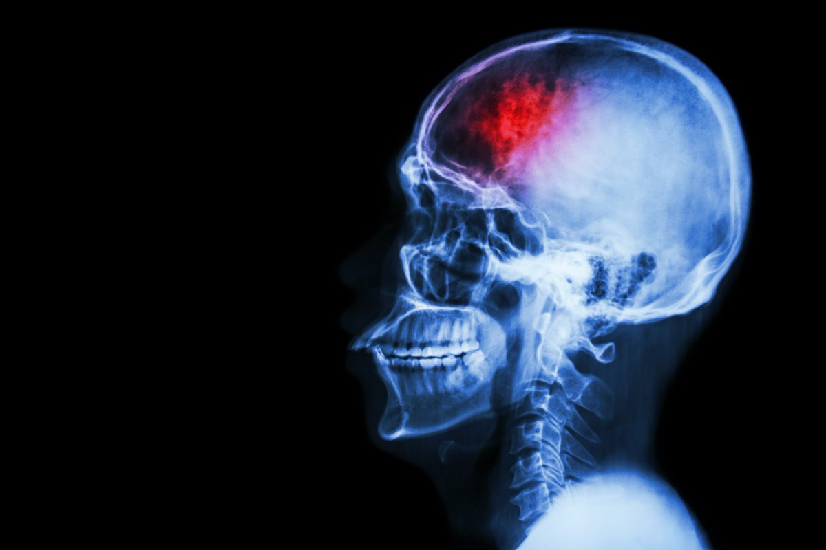 BIR_YPAT's tweet photo. Neuroimaging: What the DGH radiologist and senior registrar needs to know. Learn practical approaches to your day to day work @RCradiologists @radiologynation @EdinUniImaging
#Neurorad18 #acuteCT #emergencyimaging #patientcare #diagnosticscenarios https://t.co/ZRMtIISqwB https://t.co/0rK4yoHVMp