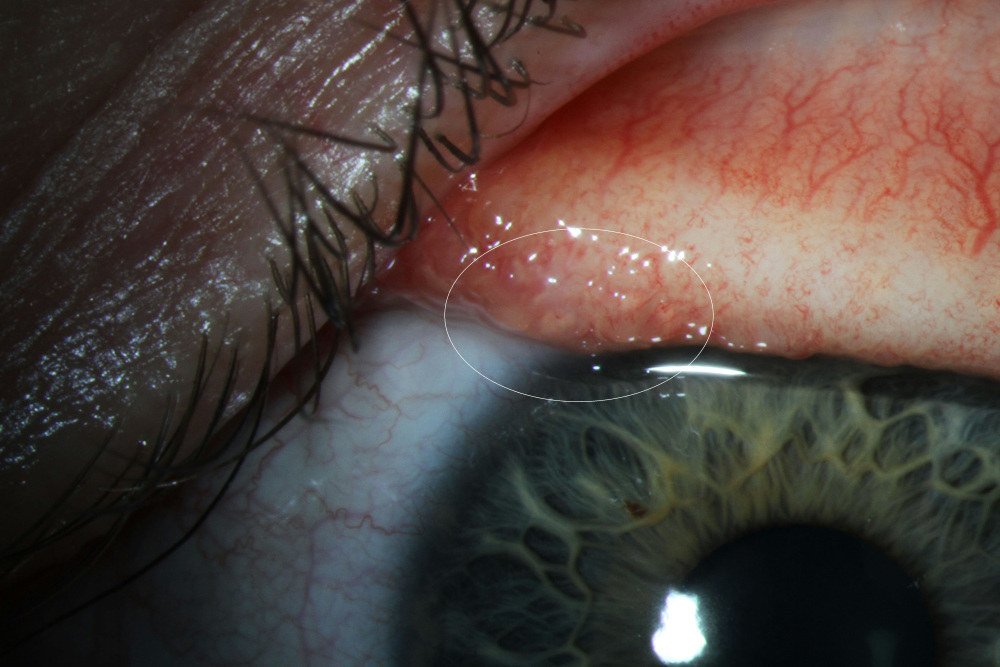 Vision2Double's tweet photo. DOUBLE VISION:
You Don't Want To Know What Was In Abby Beckley's Eye
https://t.co/5QmBwpAmgR
#AbbyBeckly #eyes
#worms
#SCREAM
#Portland #Oregon #travelling #boat #Alaska #Horrifying #Shocking #creepy #Health #doublevision #Vision2Double https://t.co/jCDk1YeL0l