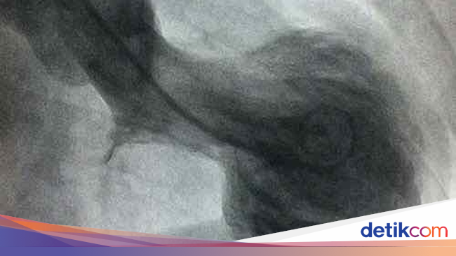 D_Autoimuncare's tweet photo. Foto Rontgen Jantung Pasien yang Diduga Kena Sindrom Patah Hati https://t.co/MuusQOToQY https://t.co/BfUF7Hgxzl