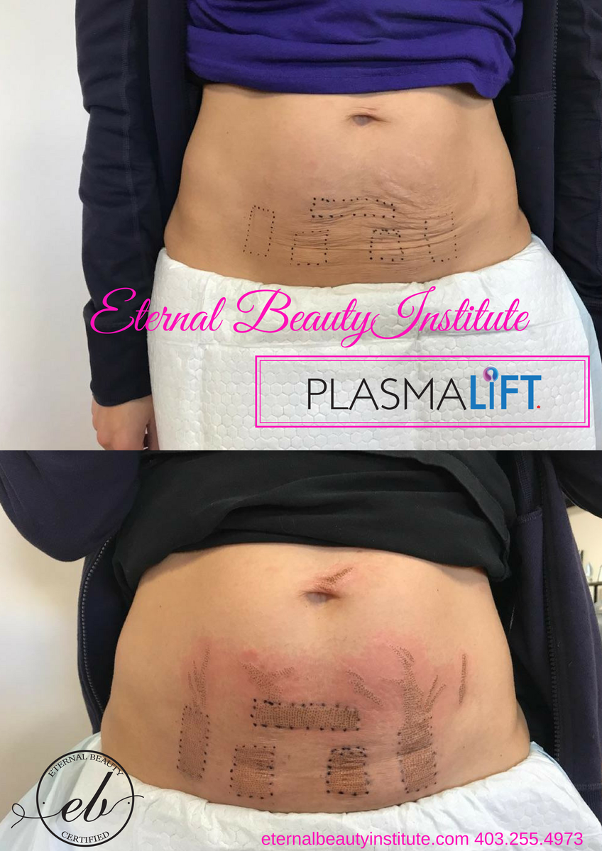 plasmaliftca's tweet photo. Amazing instant results with PlasmaLift! Tackle stretch marks, loose skin, wrinkles and even scarring! Become certified today, visit https://t.co/pbxDTRvlpY or call 1.866.330.9490 for details.
#Plasmalift #PlasmaSoftSurgeryCanada #PlasmaliftTreatment #PlasmaliftCertification https://t.co/HG2EGnUw3O
