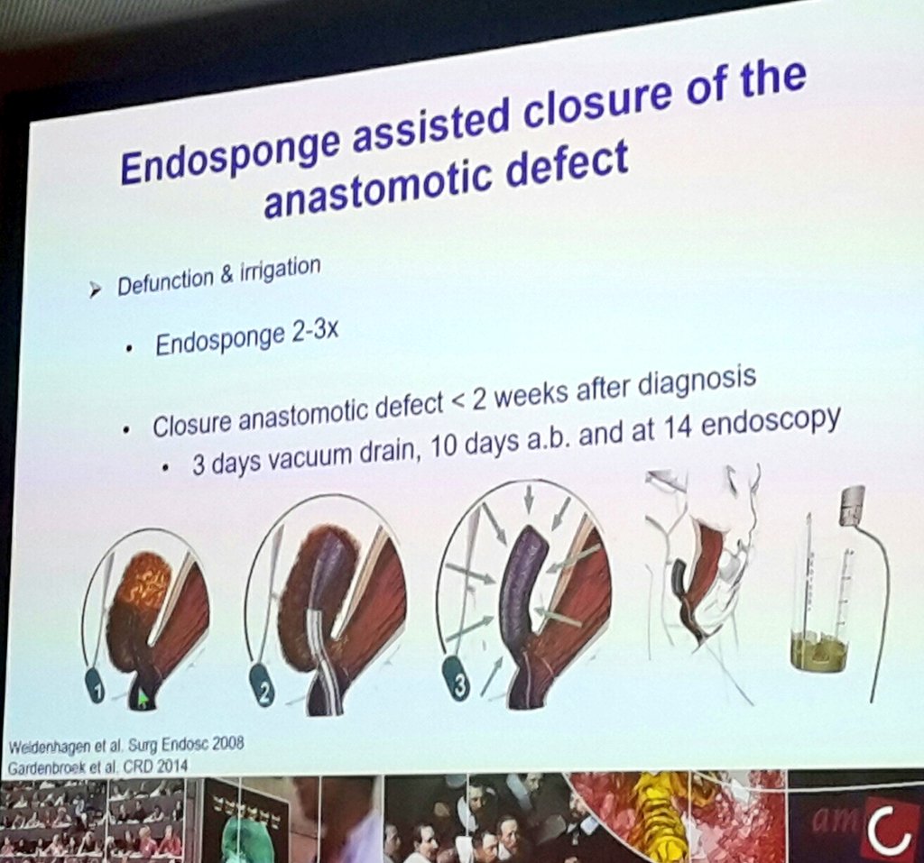 GianlucaPellino's tweet photo. @WBemelman on the leaking pouch

The role of #endosponge assisted closure

https://t.co/489qpEWpQr

https://t.co/gdymrB7qxW

#ECCO2018 #IBD #colorectalsurgery #colorectalresearch https://t.co/MZK1yCGsBf
