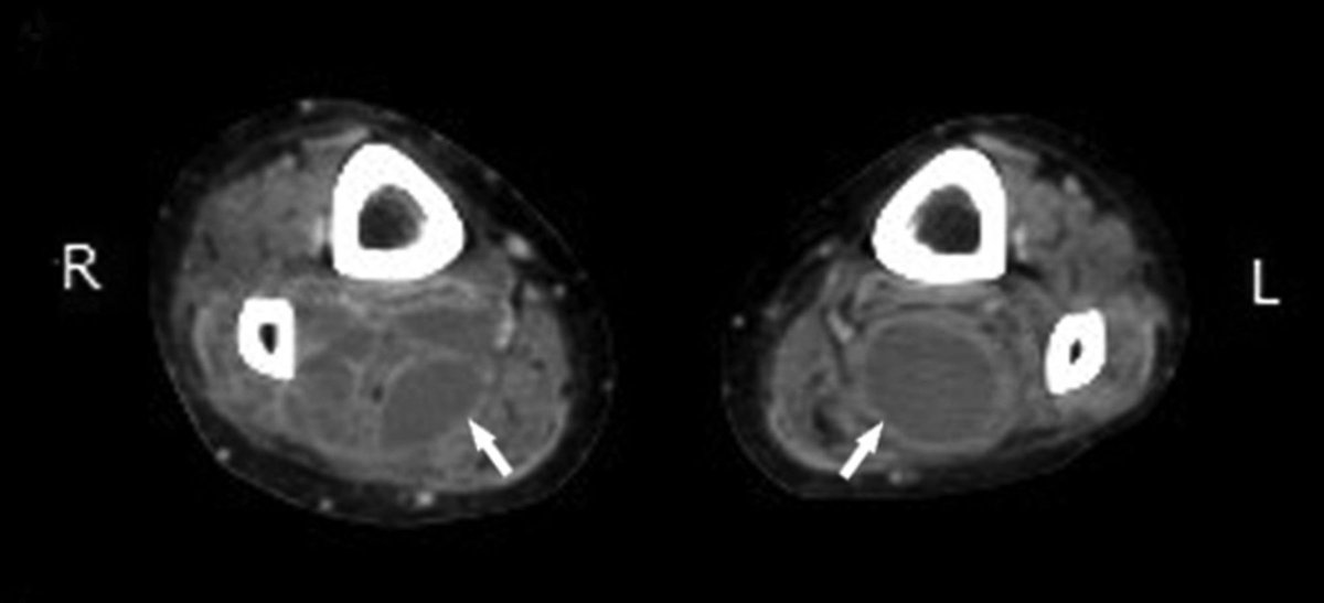 jrheum's tweet image. Candida albicans #Pyomyositis in a Patient with Systemic #Lupus Erythematosus ow.ly/8Dpd30ipadz