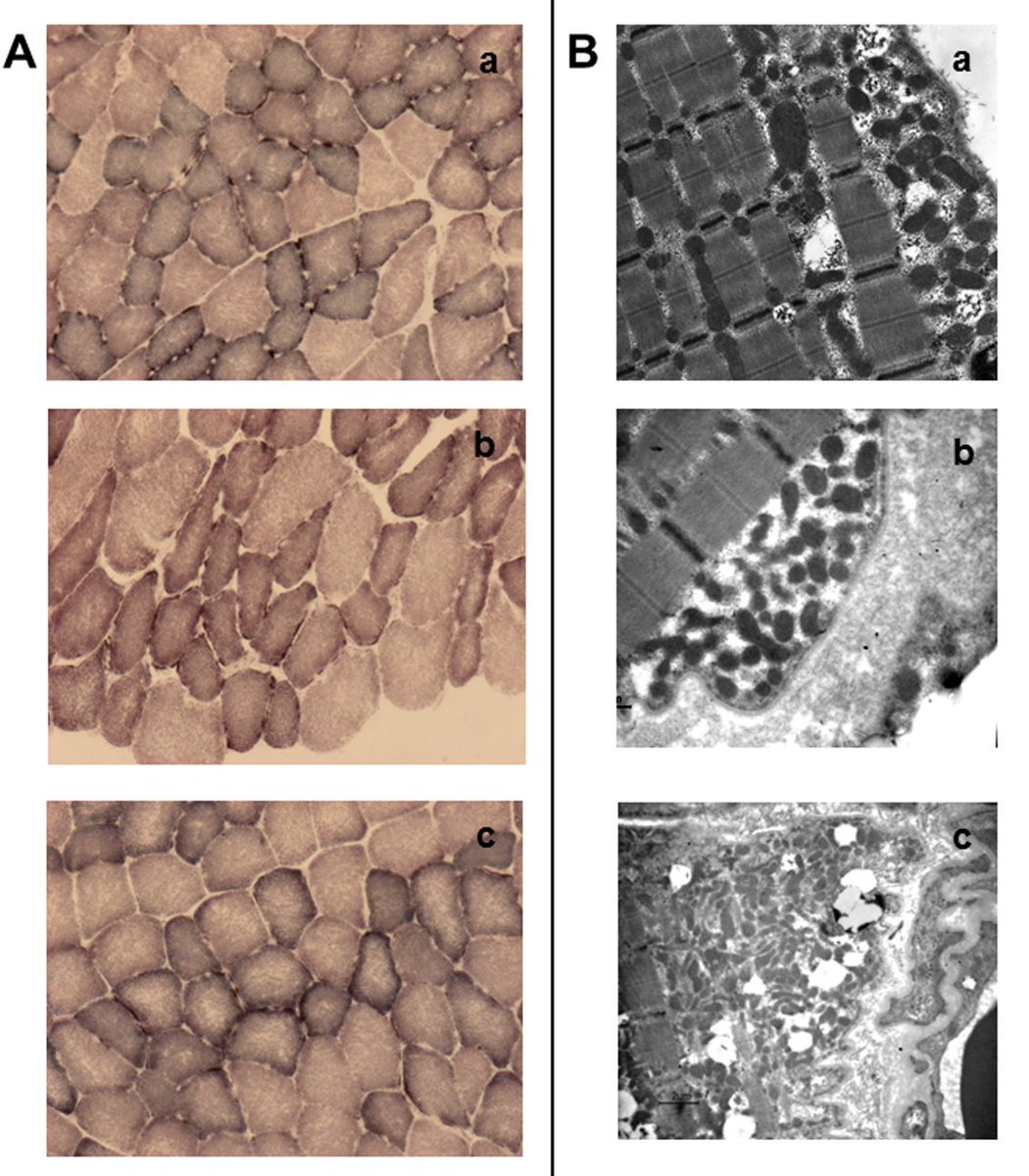 PLOSGenetics's tweet photo. #NewResearch from Caporali & Iommarini et al. https://t.co/TNxC1Ppy3O Pathogenic polymorphisms in Leber’s hereditary optic neuropathy #LHON #mitochondria #PointMutations https://t.co/RQOgr023qB